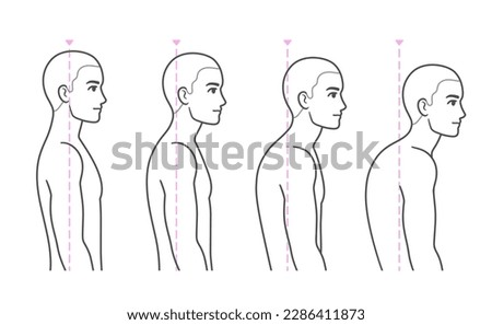 Spine kyphosis progression stages. Young man with rounded back and shoulders, forward head syndrome. Back posture problems medical diagram, vector illustration.