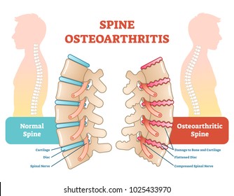 Spine osteoarthritis anatomical vector illustration diagram, educational medical scheme information. 