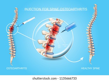 Spine Osteoarthritis Injection Realistic Vector Medical Scheme. Medications Administration With Syringe Needle To Damaged Spinal Column Area And Healthy Because Of Medical Treatment Spine Illustration