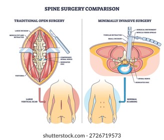 A comparação da cirurgia da coluna mostra métodos abertos versus minimamente invasivos, destacando vértebra, disco herniado e nervo espinhal para explicar a incisão e as diferenças cicatriciais. Diagrama de estrutura de tópicos