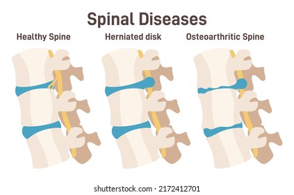 Spine vertebrae anatomy scheme. Healthy lumbar and back pain causes - spinal disc herniation and osteoarthritic. Vertebral column regions, side view with anatomical captions. Flat vector illustration