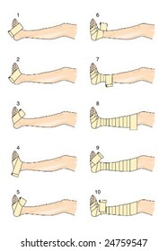 Spiral Bandage Technique Stock Vector (Royalty Free) 24759547 ...