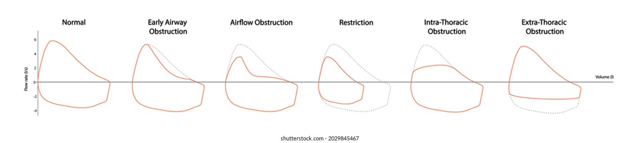 Spirometry test. Different loop of abnormal ventilatory function. 