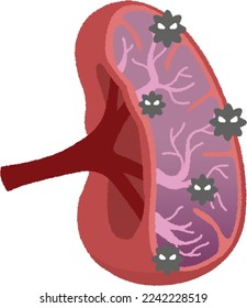 Splenitis is a condition in which the spleen becomes swollen and enlarged. It is not a disease of the spleen itself, but is caused by the effects of other diseases.