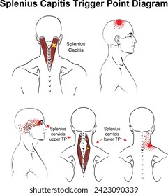 Splenius Capitis Trigger Point vector Diagram