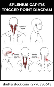Splenius Capitis Trigger Point vector Diagram