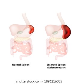 Splenomegaly of the spleen. Enlargement of the spleen. Vector illustration on isolated background