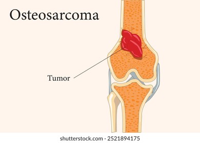 Divisão óssea revelando um tumor osteossarcoma no interior, destacando crescimento maligno e patologia óssea. seção transversal. eps 10