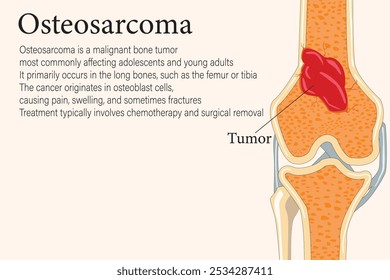 Split bone revealing an osteosarcoma tumor inside, highlighting malignant growth and bone pathology. with  description text. eps 10