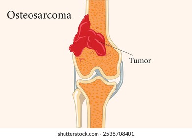 Divisão óssea revelando um tumor osteossarcoma no interior, destacando crescimento maligno e patologia óssea. seção transversal. eps 10