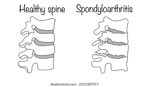 Spondyloarthritis. Eine Erkrankung der Wirbelsäule, die durch dystrophe Veränderungen der Gelenke auftritt. Einfache medizinische Illustration in Schwarz und Weiß.