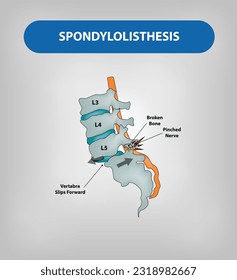 Spondylolisthesis is a condition where one vertebra in the spine slips out of position onto the vertebra below it. Vector and Illustration