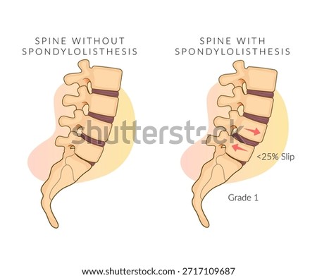 Spondylolisthesis grade 1- Spinal Joints - Stock Illustration as EPS 10 File