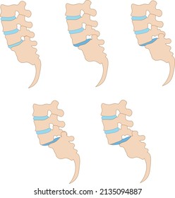 Spondylolisthesis grade, slip vertebrae, lumbar spine