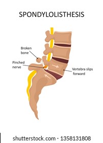 Spondylolisthese. Pinselform 
Nerv. Vektorgrafik