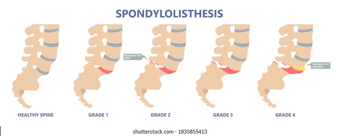 Spondylolisthesis A Spinal Disease That Causes One Of The Lower Vertebrae To Slip Forward Disk Hip Pain Bone Birth Defect Injury Sports Accident Exam Nerve Epidural Steroid Injections Fusion Leg