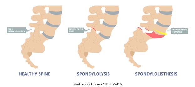 Spondylolisthesis A Spinal Disease That Causes One Of The Lower Vertebrae To Slip Forward Disk Hip Pain Bone Birth Defect Injury Sports Accident Exam Nerve Epidural Steroid Injections Fusion Leg