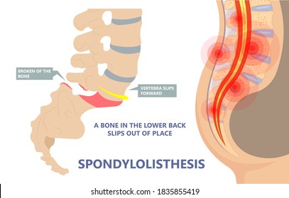 Spondylolisthesis A Spinal Disease That Causes One Of The Lower Vertebrae To Slip Forward Disk Hip Pain Bone Birth Defect Injury Sports Accident Exam Nerve Epidural Steroid Injections Fusion Leg