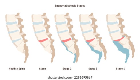 Spondylolisthesis. Spinal disease when lower vertebrae slip forward. Birth defect or injury damage. Flat vector illustration