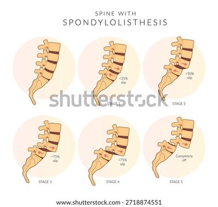 Spondylolisthesis Stage 1 to 5 - Spinal Joints - Stock Illustrationas EPS 10 File