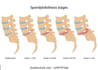 Spondylolisthesis stages with main description. Healthy spine and spine with spondylolisthesis in lateral view are isolated on white background. Vector illustration