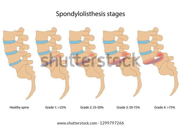 Spondylolissephasen Mit Hauptbeschreibung Gesunde Wirbelsaule Und Stock Vektorgrafik Lizenzfrei