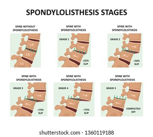 Spondylolisthesis stages. Vector illustration