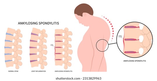 spondylolysis fused spine disk of kyphosis lordosis or scoliosis kyphoscoliosis disease in axial ankylosing spondylitis osteoporosis the skeletal pelvis stiffness with chronic knee ankle