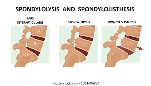 Spondylolysis  and  spondylolisthesis 