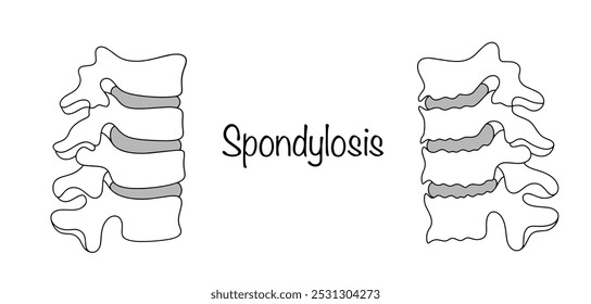 Espondilosis. Enfermedad crónica en la que el tejido óseo crece en la superficie de los cuerpos vertebrales, lo que lleva a su deformación. Dibujó la columna vertebral sana y la columna vertebral con enfermedad. Ilustración vectorial.