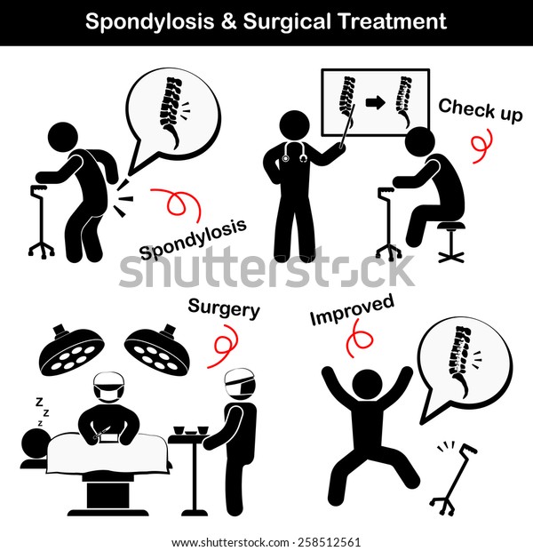 Spondylosis Spondylolisthesis Surgical Treatment Pictogram Old Stock ...