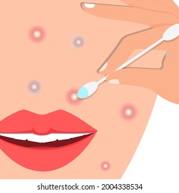 Spot application for acne. Problem skin care. A cotton swab is soaked in a salicylic acid solution. A woman's face with sore, red ulcers. Vector illustration, flat color cartoon design.