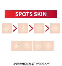 Spots skin to clear steps vector illustration