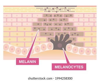 Spotted skin cross section. Melanin and melanocytes. Adverse effects of ultraviolet.  Pale colored illustration in flat cartoon style.