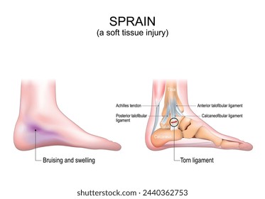 Esguince. Una lesión de tejido blando en el pie humano. Hematoma e hinchazón de la piel de la pierna. Primer plano de un tendón de Aquiles, huesos del pie y ligamentos. Desgarro del ligamento calcáneo-peroneo. Ilustración de vector