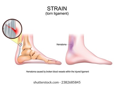 Sprain. Torn ligament after Painful foot twist. Signs and symptoms of a Soft tissue injury. Muscle damage, tendon tear, ligament problem description. Sports Trauma and Rehabilitation. Vector