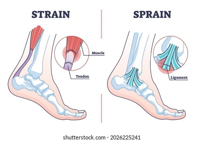 Sprain vs strain anatomical comparison as medical foot injury outline diagram. Labeled educational orthopedic muscle, tendon and ligament problem description vector illustration. Painful foot twist.