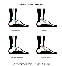 Sprained ankle grades. Twisted feet, pain and swelling. Tears, stretch or rupture of ligaments. Foot trauma anatomical poster, diagnosis and treatment in clinic. Leg injury, X ray vector illustration