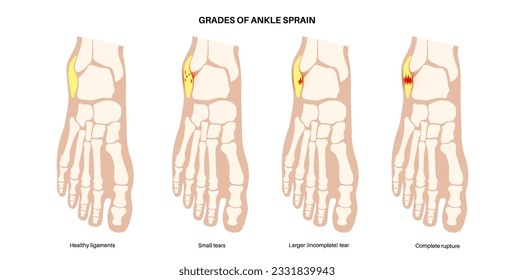 Sprained ankle grades. Twisted feet, pain and swelling. Tears, stretch or rupture of ligaments. Foot trauma anatomical poster, diagnosis and treatment in clinic. Leg injury, X ray vector illustration