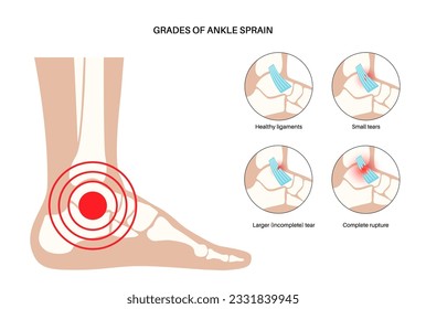 Sprained ankle grades. Twisted feet, pain and swelling. Tears, stretch or rupture of ligaments. Foot trauma anatomical poster, diagnosis and treatment in clinic. Leg injury, X ray vector illustration