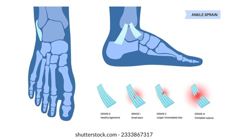 Sprained ankle grades. Twisted feet, pain and swelling. Tears, stretch or rupture of ligaments. Foot trauma anatomical poster, diagnosis and treatment in clinic. Leg injury, X ray vector illustration