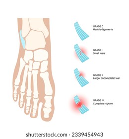 Sprained ankle grades. Twisted feet, pain and swelling. Tears, stretch or rupture of ligaments. Foot trauma anatomical poster, diagnosis and treatment in clinic. Leg injury, X ray vector illustration