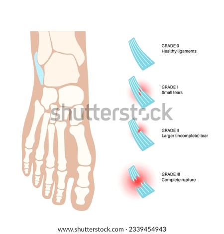 Sprained ankle grades. Twisted feet, pain and swelling. Tears, stretch or rupture of ligaments. Foot trauma anatomical poster, diagnosis and treatment in clinic. Leg injury, X ray vector illustration