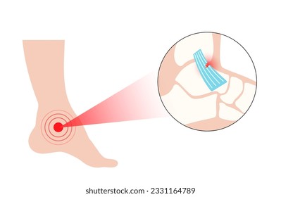 Sprained ankle injury. Twisted feet, pain and swelling. Tears, stretch or rupture of ligaments. Foot trauma anatomical poster, diagnosis and treatment in clinic. Leg problem, X ray vector illustration