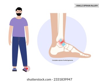 Herida en el tobillo rociado. Pies torcidos, dolor e hinchazón. Lágrimas, estiramiento o ruptura de ligamentos. Afiche anatómico, diagnóstico y tratamiento en clínica de traumatismos de pies. Problema de la pierna, ilustración vectorial de rayos X