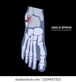 Sprained ankle injury. Twisted feet, pain and swelling. Tears, stretch or rupture of ligaments. Foot trauma anatomical poster, diagnosis and treatment in clinic. Leg problem, X ray vector illustration