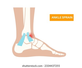 Sprained ankle injury. Twisted feet, pain and swelling. Tears, stretch or rupture of ligaments. Foot trauma anatomical poster, diagnosis and treatment in clinic. Leg problem, X ray vector illustration