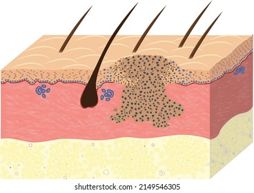 Squamous Carcinoma Of Skin, Histology, Vector