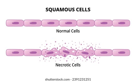 Squamous Cells - Normal Epithelial Cell - Necrotic Cell - Histology Medical Vector Illustration