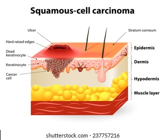 Carcinoma de células escamosas ou câncer de células escamosas.